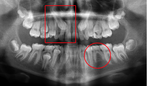 Radiographie panoramique montrant une canine maxillaire incluse et une agénésie de prémolaire infèrieure